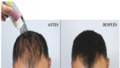 producto para la calvicie, alopecie resultados inmediatos